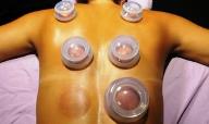 cupping massage van rug, nek en schouders bij www.wellness-massage-uithoorn.nl. vacuum therapie, koppen zetten.
Door middel van siliconen cups wordt een vacuum gecreeerd. De cups laat ik op knelpunten echt even zitten. Verder wordt er met de vastgezogen cups gemasseerd. 